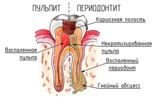 К чему приводит кариес, если его не лечить?