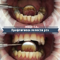 Профессиональная гигиена - польза для зубов и преображение улыбки!