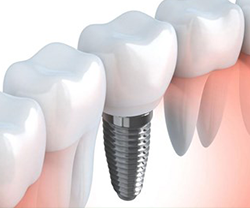 экспресс-имплантация за 4 дня